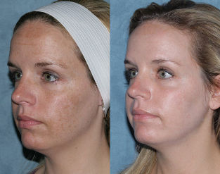 Avant et après les fractions de rajeunissement du visage