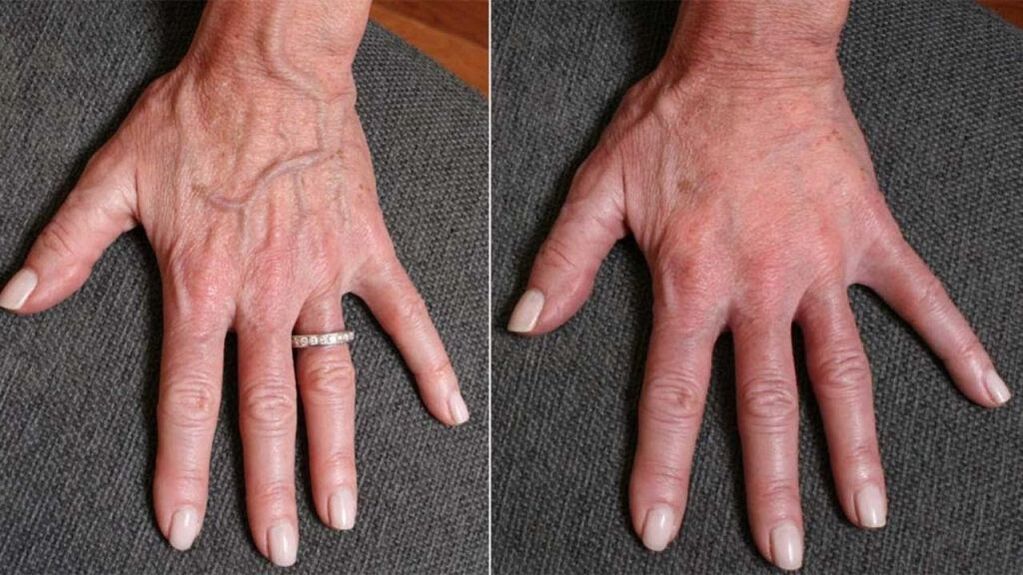 Contour plastique, rajeunissement des mains Photo 1 avant et après
