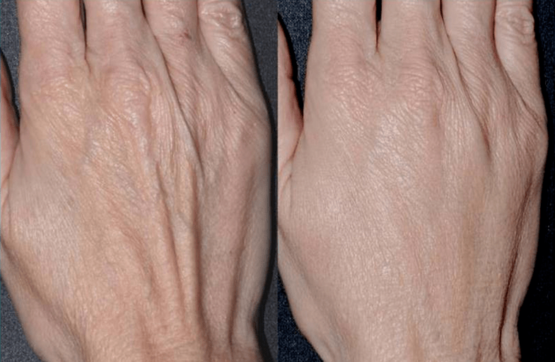 Contour plastique, rajeunissement des mains Photo 2 avant et après